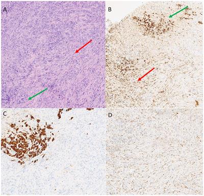 Pathological complete response in a patient with pleural mesothelioma treated with immunotherapy: a case report